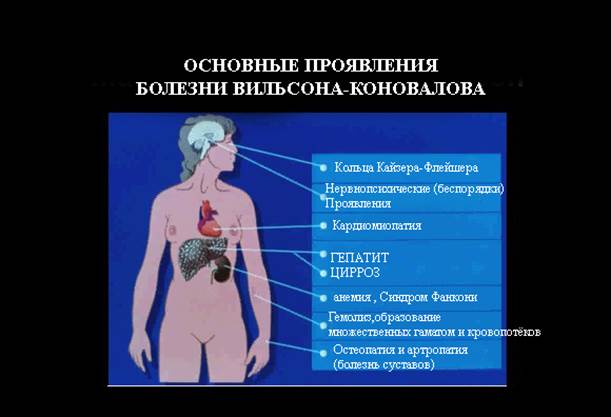 Болезнь вильсона. Органы мишени при болезни Вильсона Коновалова. Синдром Вильсона Коновалова симптомы. Синдромы при болезни Вильсона Коновалова. Церулоплазмин при болезни Вильсона Коновалова.