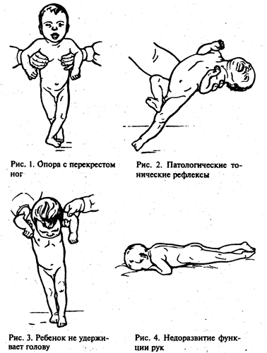 Четыре уровня доречевого развития детей с ДЦП - student2.ru