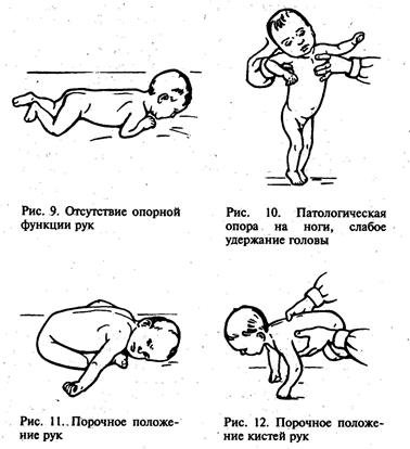 Четыре уровня доречевого развития детей с ДЦП - student2.ru