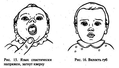 Четыре уровня доречевого развития детей с ДЦП - student2.ru