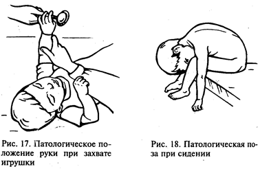 Четыре уровня доречевого развития детей с ДЦП - student2.ru