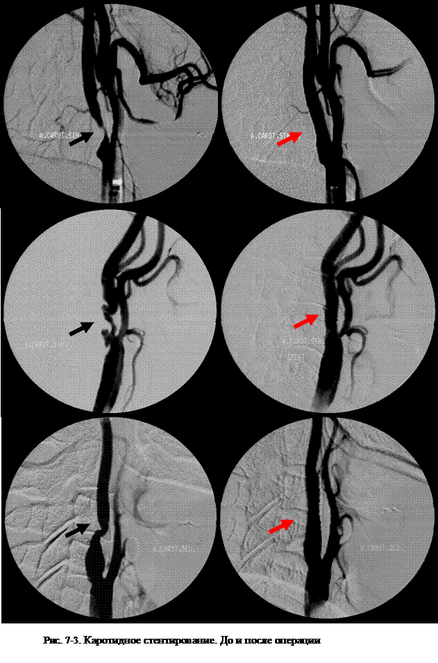 Чрескожная транслюминальная ангиопластика со стентированием - student2.ru