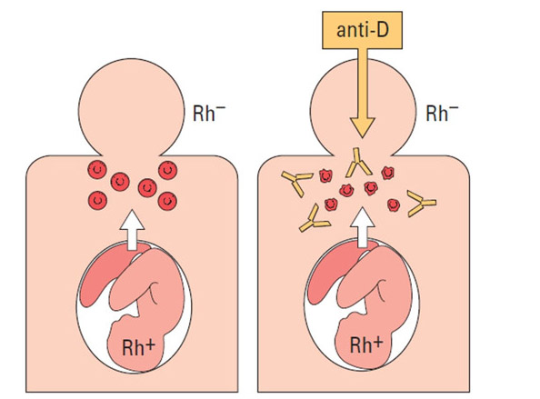 Что следует знать и помнить женщинам, награжденным отрицательным резус-фактором? - student2.ru