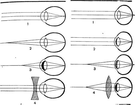 дальнозоркость и близорукость - student2.ru