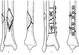 Диафизарные переломы костей голени - student2.ru