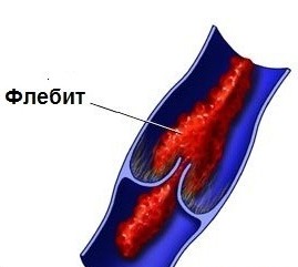 Диагностика и профилактика осложнений при катетеризации периферических вен - student2.ru