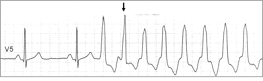 Диагностика. Клинические проявления. Электрокардиографическая диагностика ЖТ строится на признаках, подтверждающих ее происхождение из миокарда желудочков или отделов проводящей системы сердца - student2.ru