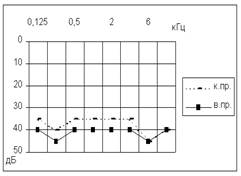 Диагностика сенсоневральной тугоухости - student2.ru