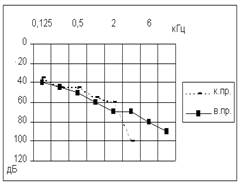 Диагностика сенсоневральной тугоухости - student2.ru