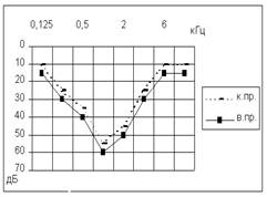 Диагностика сенсоневральной тугоухости - student2.ru