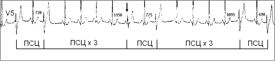 Диагностика. Электрокардиографическая морфология желудочковых парасистолических комплексов аналогична желудочковой экстрасистолии - student2.ru