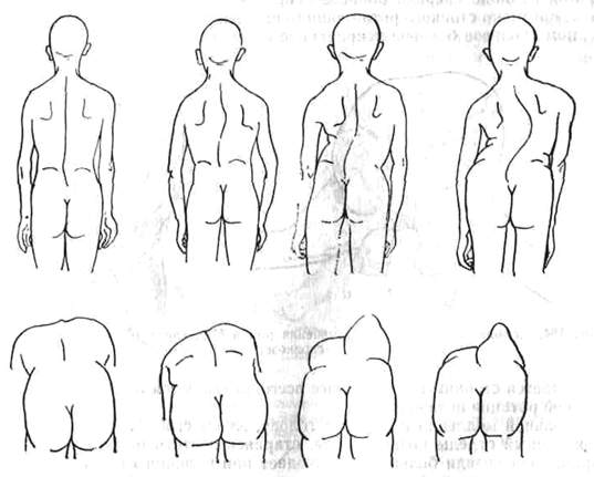 Дифференциальна диагностика младенческих сколиозов - student2.ru