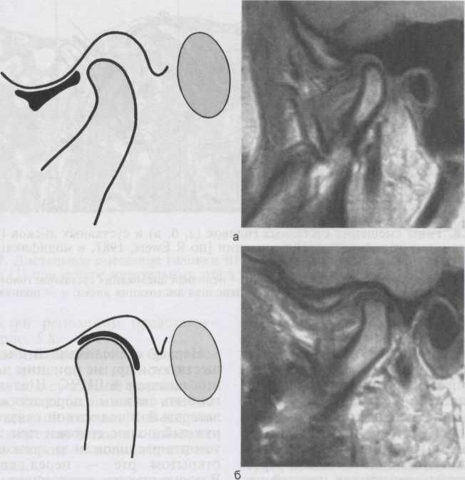 дислокация суставного диска. - student2.ru