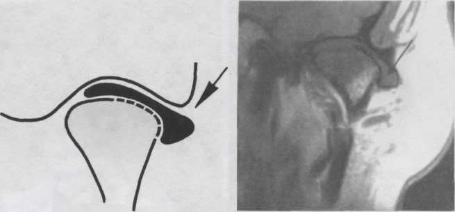 дислокация суставного диска. - student2.ru