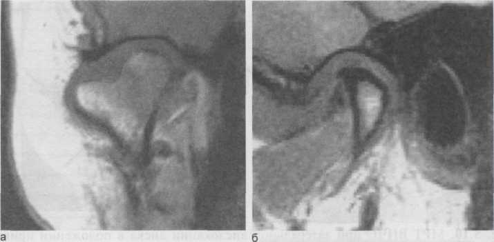 дислокация суставного диска. - student2.ru