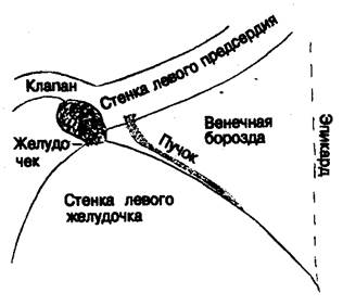 Добавочные атриовентрикулярные пути - student2.ru