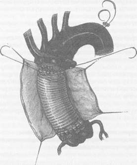 Дозированная резекция аневризмы восходящей аорты с интимосохраняющим экзопротезированием аорты - student2.ru