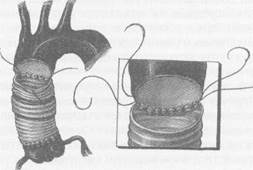 Дозированная резекция аневризмы восходящей аорты с интимосохраняющим экзопротезированием аорты - student2.ru