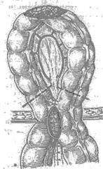 двухмоментная резекция ободочной кишки по способу грекова ii - student2.ru