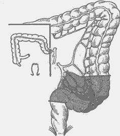 двухмоментная резекция ободочной кишки по способу грекова ii - student2.ru