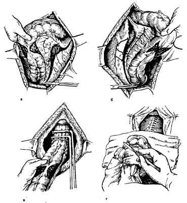двухмоментная резекция ободочной кишки по способу грекова ii - student2.ru