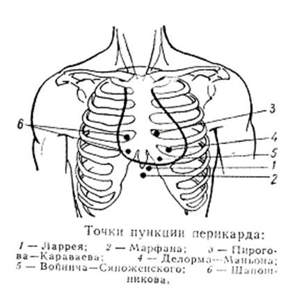 Лапороцентез с «шарящим» катетером. - student2.ru