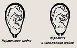 EПеринеотомия. Эпизиотомия - student2.ru