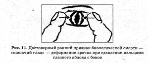 Если в течение 7—10 секунд пульса на сонной артерии отсутствует, считается, что сердце в данном случае не работает. - student2.ru