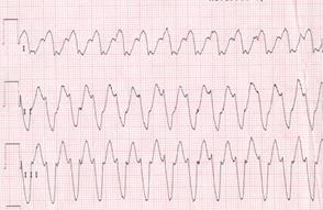 фибриллляция и трепетание желудочков - student2.ru