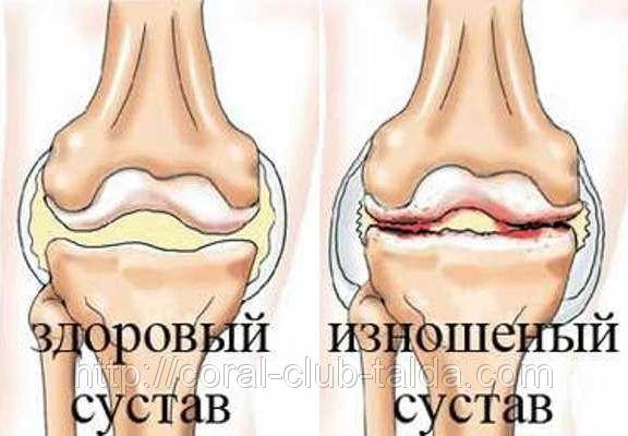 Фиброматоз подошвенного апоневроза ( болезнь Леддерхоза ) - student2.ru