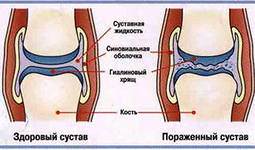 Фиброматоз подошвенного апоневроза ( болезнь Леддерхоза ) - student2.ru