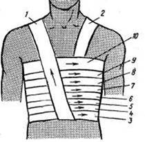 Фиксирующая повязка при переломах ребер и ушибах грудной клетки, техника наложения. - student2.ru