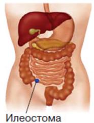 Гастростома, илеостома арқылы науқасты тамақтандыру - student2.ru