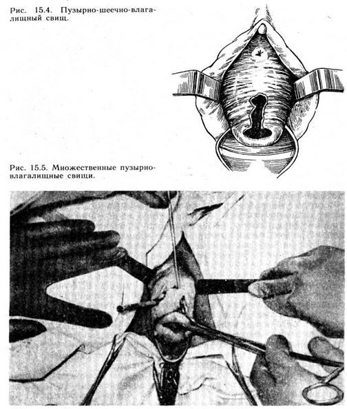 генитальные свищи и посттравматические изменения половых органов - student2.ru