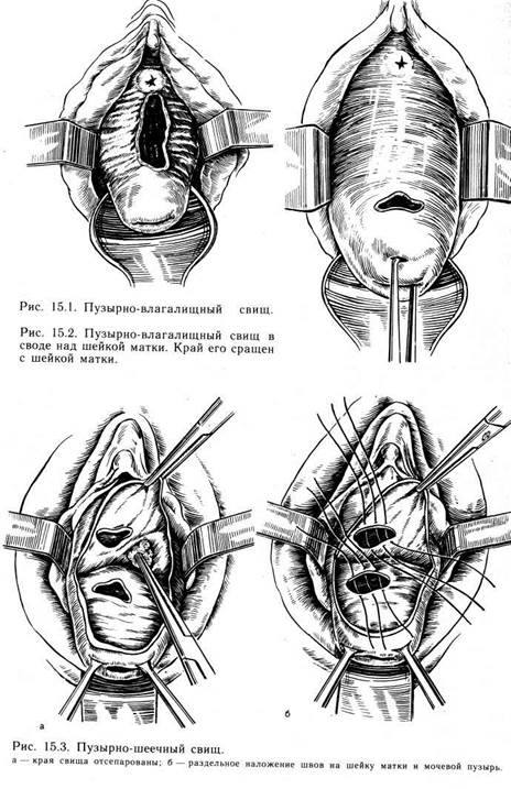 генитальные свищи и посттравматические изменения половых органов - student2.ru