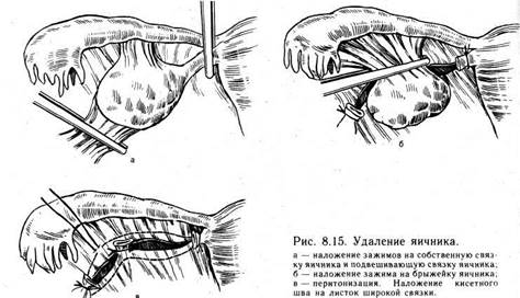 гиперпластические процессы в яичниках - student2.ru