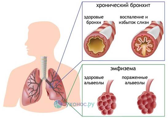 Глава 1. Хроническая обструктивная болезнь легких и ее особенности - student2.ru