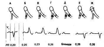 ГЛАВА 3. Атриовентрикулярная блокада: неинвазивный подход - student2.ru