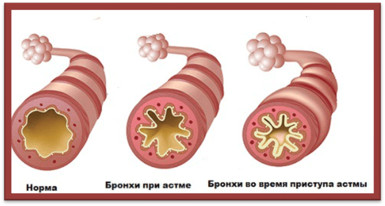 глава i. бронхиальная астма. - student2.ru