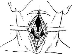 Горизонтальная резекция гортани - student2.ru