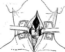 Горизонтальная резекция гортани - student2.ru