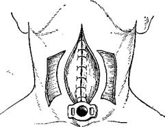 Горизонтальная резекция гортани - student2.ru