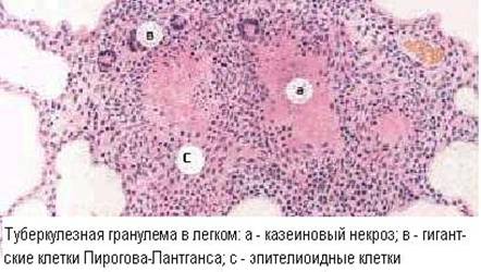 Гранулёматозная гиперчувствительность - student2.ru