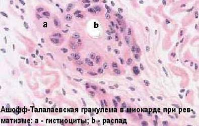 Гранулёматозная гиперчувствительность - student2.ru