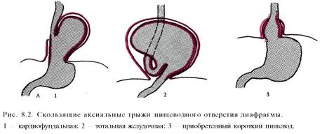 Грыжи пищеводного отверстия диафрагмы .Классификация. Клиника, диагностика. Показания к оперативному лечению - student2.ru