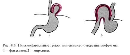 Грыжи пищеводного отверстия диафрагмы. Классификация. Клиника, диагностика. Показания к оперативному лечению - student2.ru