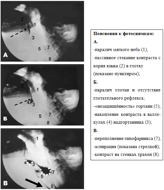 II. Дисфункция мышц глотки, верхнего отдела пищевода, надподъязычных мышц - student2.ru