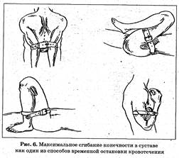 I. Поэтому первым (и главным) принципом оказания первой помощи при ранениях является остановка кровотечения любым доступным на данный момент способом - student2.ru