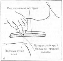 и проксимальную часть медиальной подкожной - student2.ru