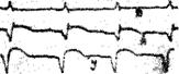 экг при коронарной недостаточности - student2.ru